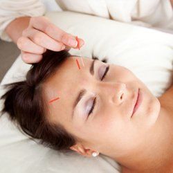 Acupuncture