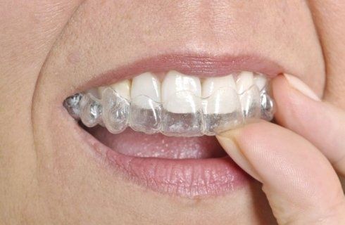 mascherine per denti, apparecchi per denti, soluzioni per denti