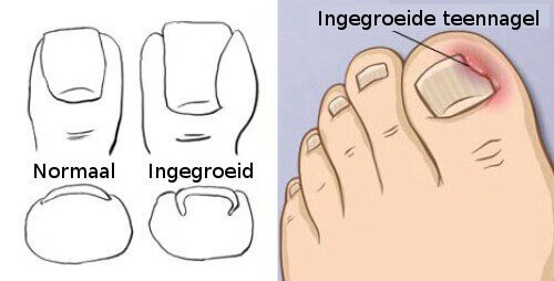 Diagram van een normale teennagel en een ingegroeide teennagel, met een illustratie van de voet die het aangetaste gebied markeert.