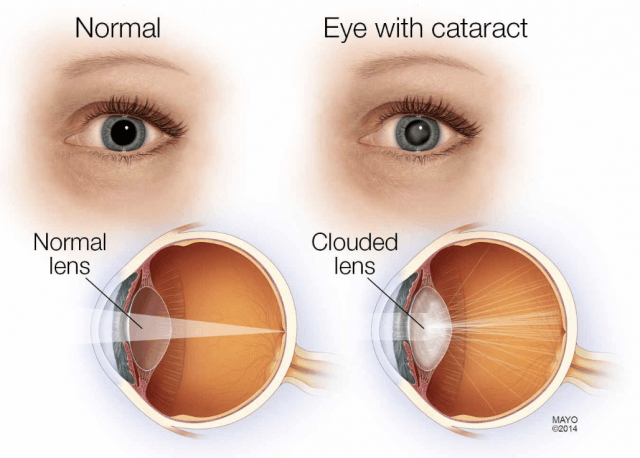 Glasses — Diagram of Eyes and Cataract in Belleair Bluffs, FL