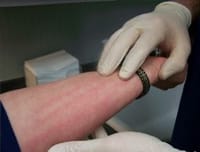 rashes