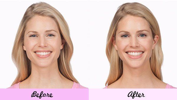 Woman Before and After Botox — Big Rapids, MI — Crew & Boss Eye Associates Woman Before and After Botox — Big Rapids, MI — Crew & Boss Eye Associates