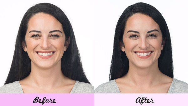 Lady Before and After Botox — Big Rapids, MI — Crew & Boss Eye Associates Lady Before and After Botox — Big Rapids, MI — Crew & Boss Eye Associates