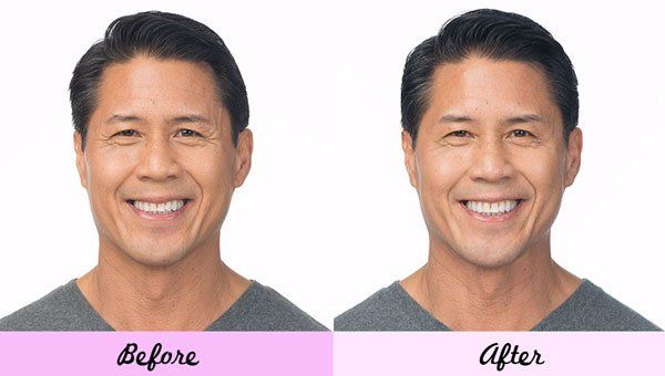 Man Before and After Botox — Big Rapids, MI — Crew & Boss Eye Associates Man Before and After Botox — Big Rapids, MI — Crew & Boss Eye Associates