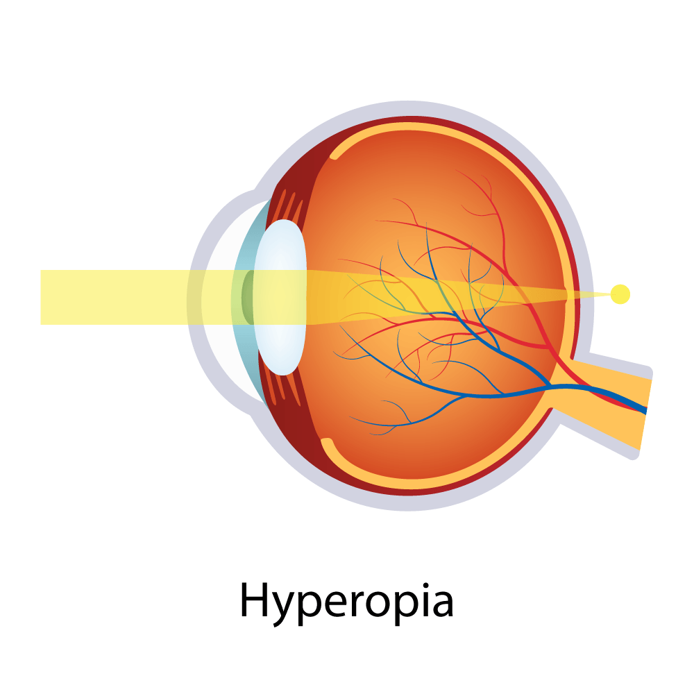 Hyperopia — Big Rapids, MI — Crew & Boss Eye Associates Hyperopia — Big Rapids, MI — Crew & Boss Eye Associates