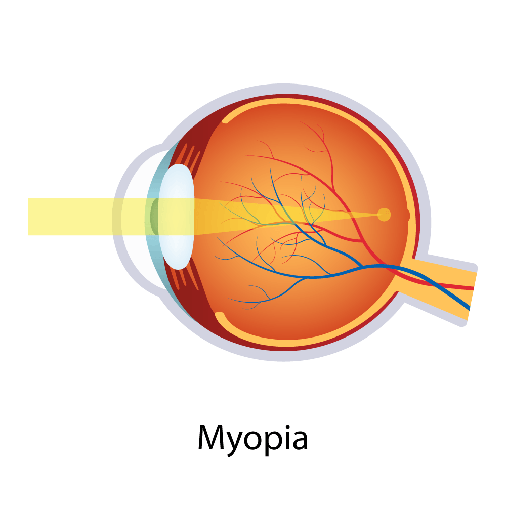 Myopia — Big Rapids, MI — Crew & Boss Eye Associates Myopia — Big Rapids, MI — Crew & Boss Eye Associates