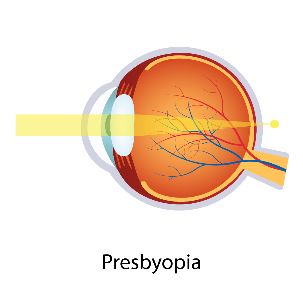 Presbyopia — Big Rapids, MI — Crew & Boss Eye Associates Presbyopia — Big Rapids, MI — Crew & Boss Eye Associates