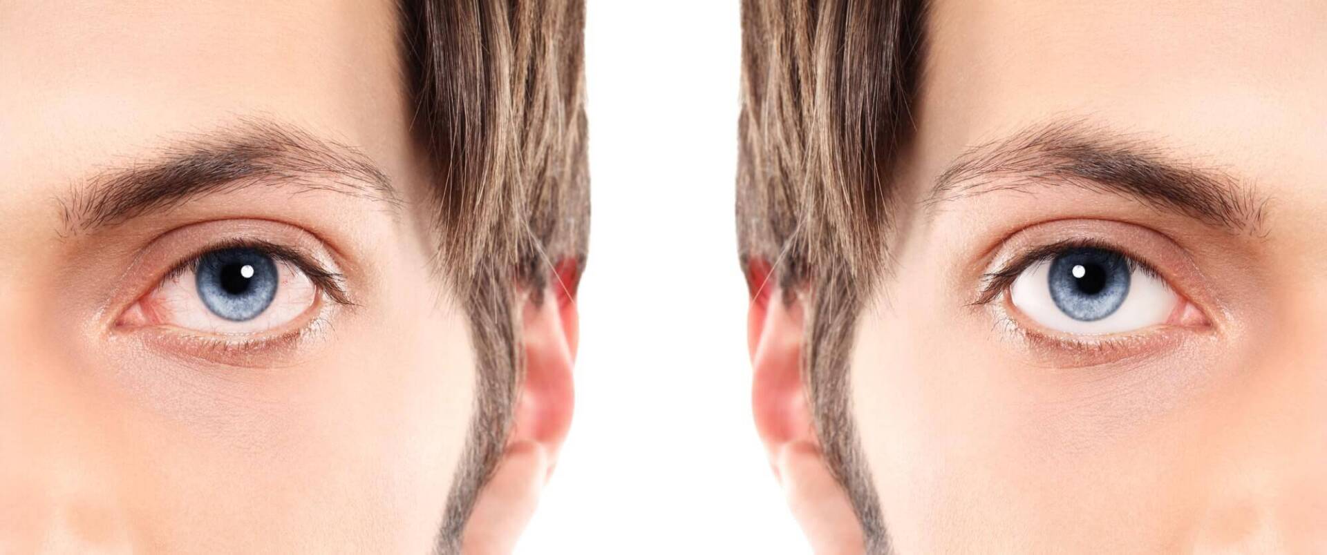 עיניים יבשות