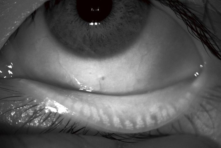 Close-up black-and-white photo of a human eye above a closed eyelid