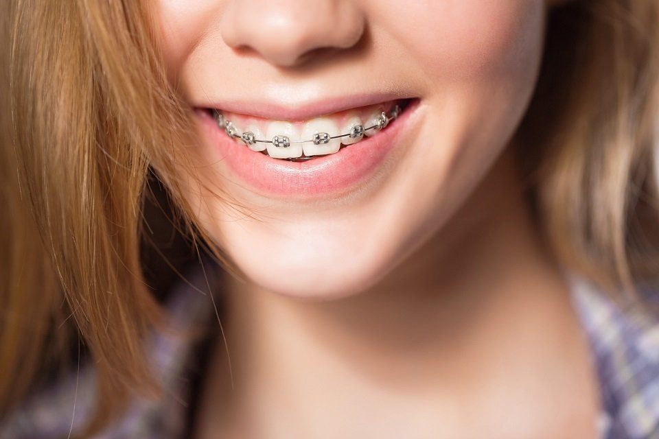 Apparecchio dentale