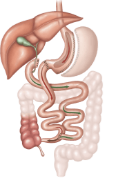 weight loss surgery mini bypass