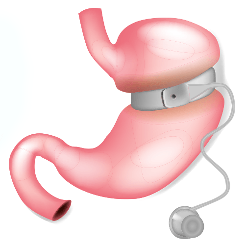 Gastric Band Procedure