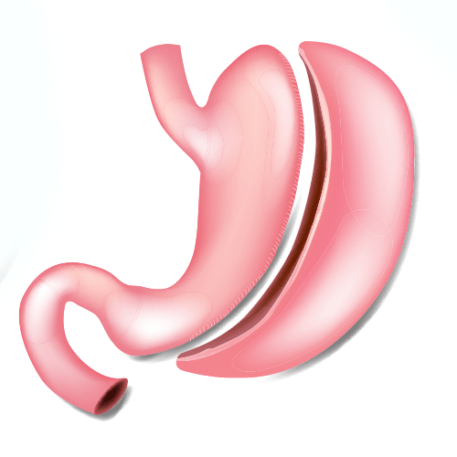 Gastric Sleeve Surgery