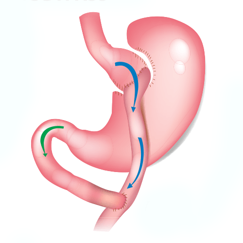 Gastric Bypass Surgery