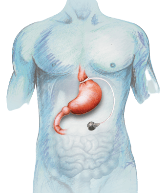 Gastric Band Surgery