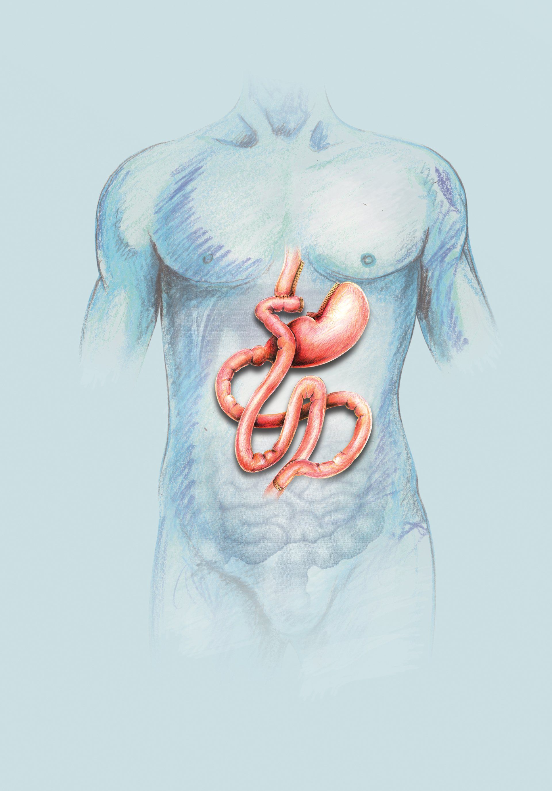Gastric Bypass image