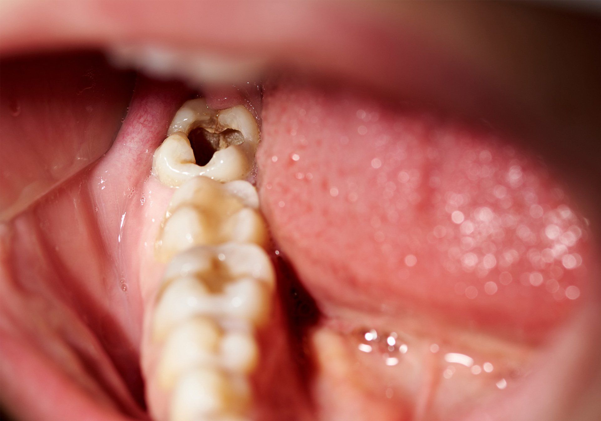 Tooth — Damaged Tooth in Henderson, NC Tooth — Damaged Tooth in Henderson, NC