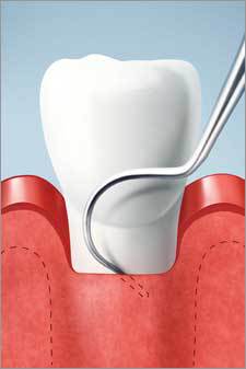 Diagram of an exam to determine if treatment for Gum Grafting is needed by Nassau County Periodontist, Dr. Marichia Attalla in Williston Park, NY 11596