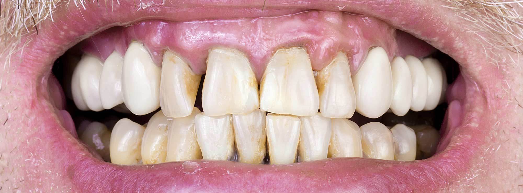 Receding Gum Treatment by Nassau County Periodontist Dr. Stephanie Sfiroudis DDS, MS