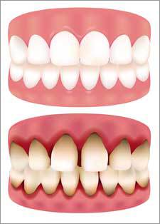 A mouth with healthy gums and one in need of Receding Gum Treatment by Nassau County Periodontist, Dr. Marichia Attalla in Williston Park, NY 11596