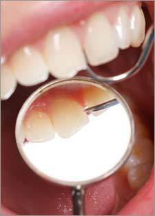 Healthy teeth after treatment for Gum Diseases by Nassau County Periodontist.