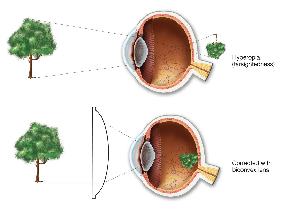 Illustrazione che mostra la condizione dell'occhio ipermetrope e la correzione con una lente convessa.
