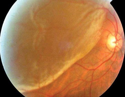 Fotografia del fondo oculare che mostra il distacco della retina con una retina bianca, prominente e staccata.