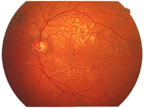 Immagine del fondo oculare, che mostra vasi sanguigni e macchie giallastre indicative di degenerazione maculare.