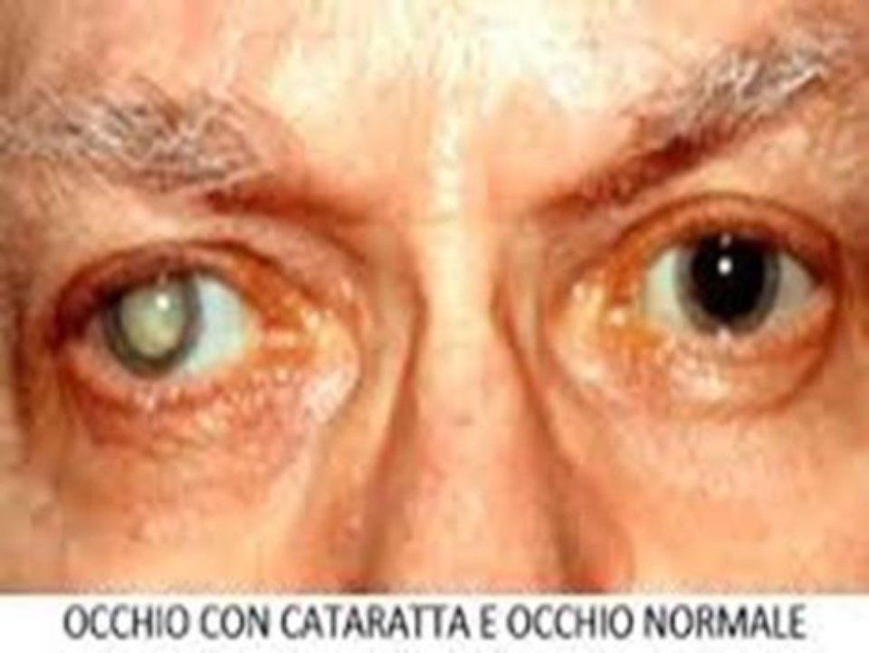Primo piano degli occhi di una persona, uno con cataratta (cristallino opacizzato), l'altro normale.