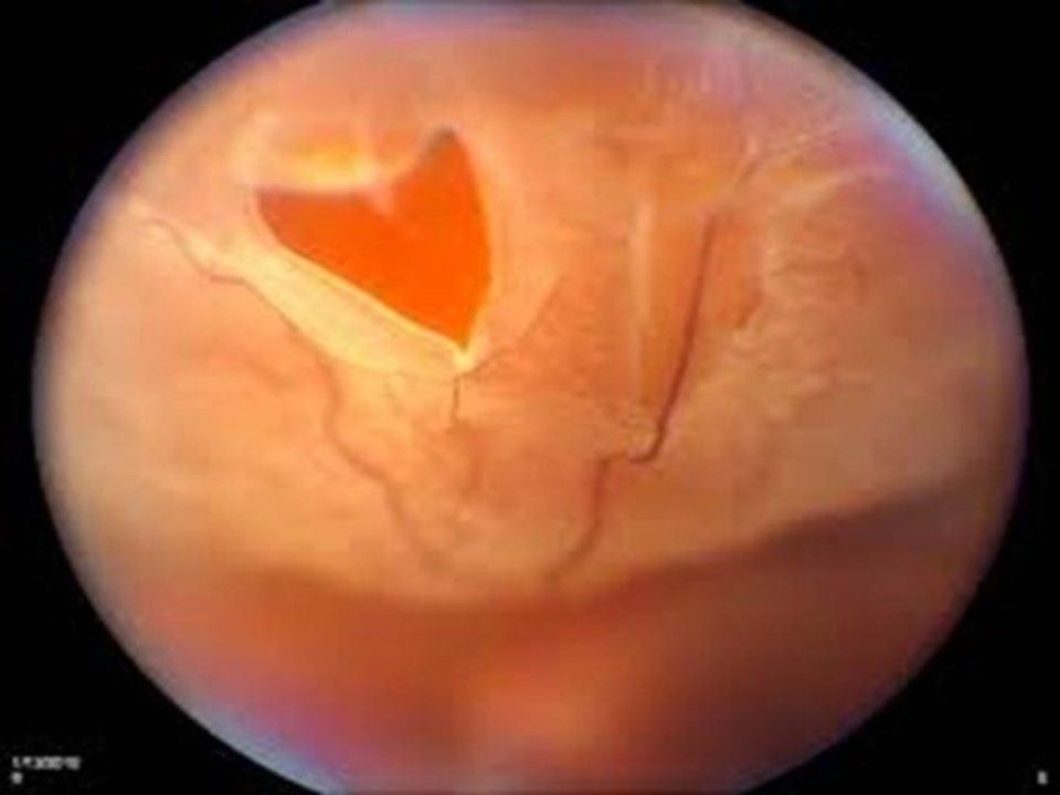 Scansione della retina che mostra una pozza di sangue rosso vivo all'interno dell'occhio, probabilmente dovuta a un'emorragia.