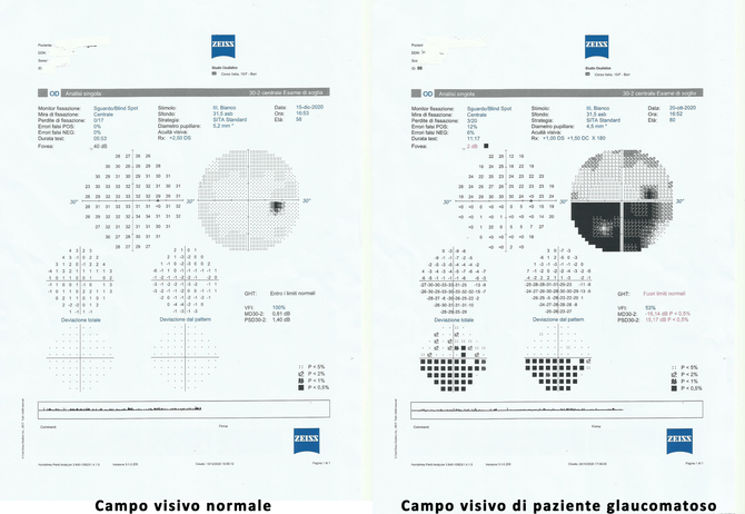 Confronto tra due grafici di esami della vista: visione normale vs. visione affetta da glaucoma.