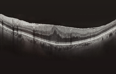 Scansione OCT dell'occhio, che mostra strati retinici con gonfiore e sacche di liquido.