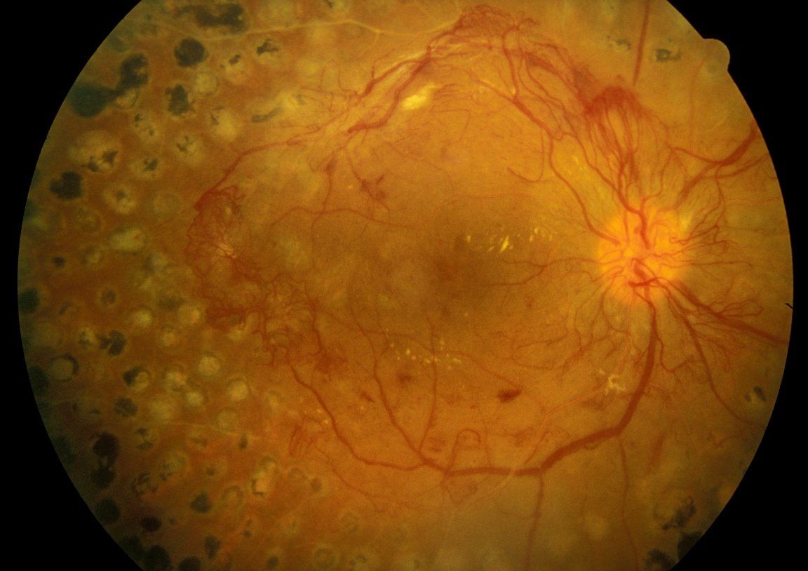 L'esame della retina evidenzia il distacco della retina, i vasi sanguigni e il disco ottico.