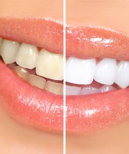 Before and After Dental - Special Smiles, San Diego, Imperial Beach