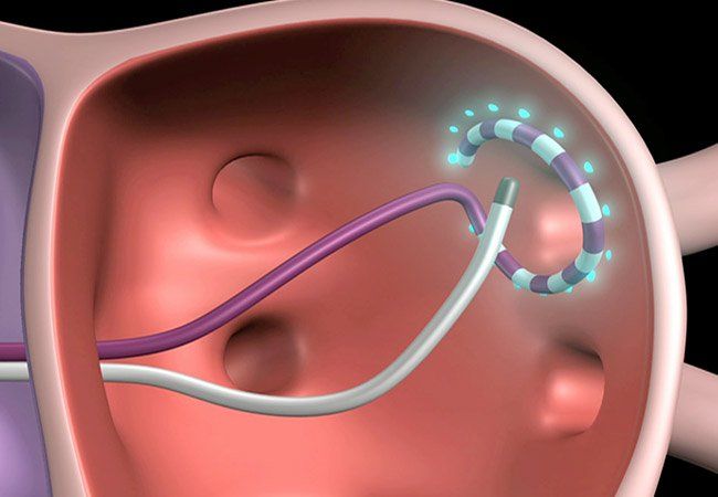 rf ablation