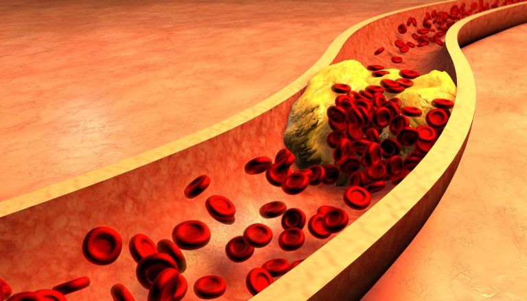 peripheral vascular disease