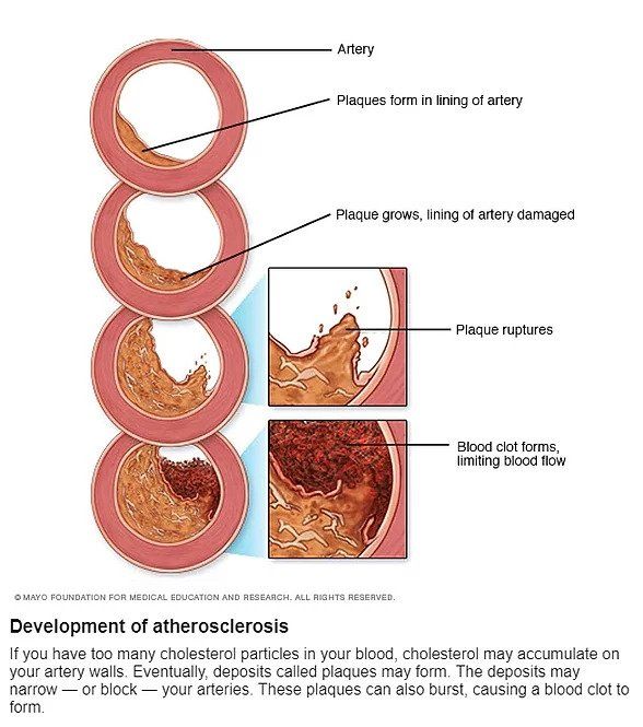 coronary artery disease