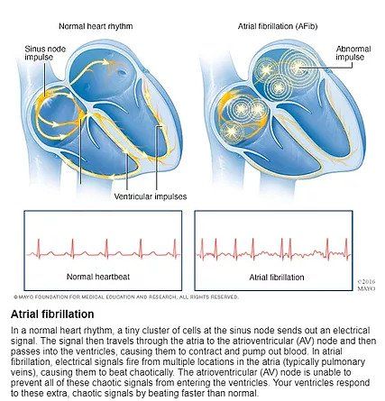 atrial fibrillation