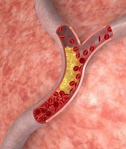 high cholesterol