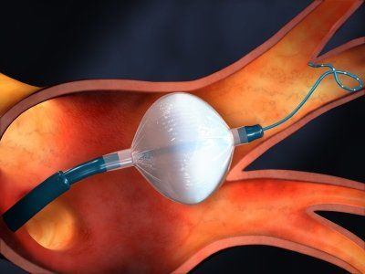 cryoablation