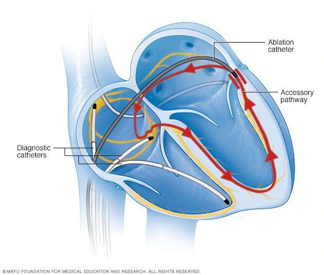 rf ablation