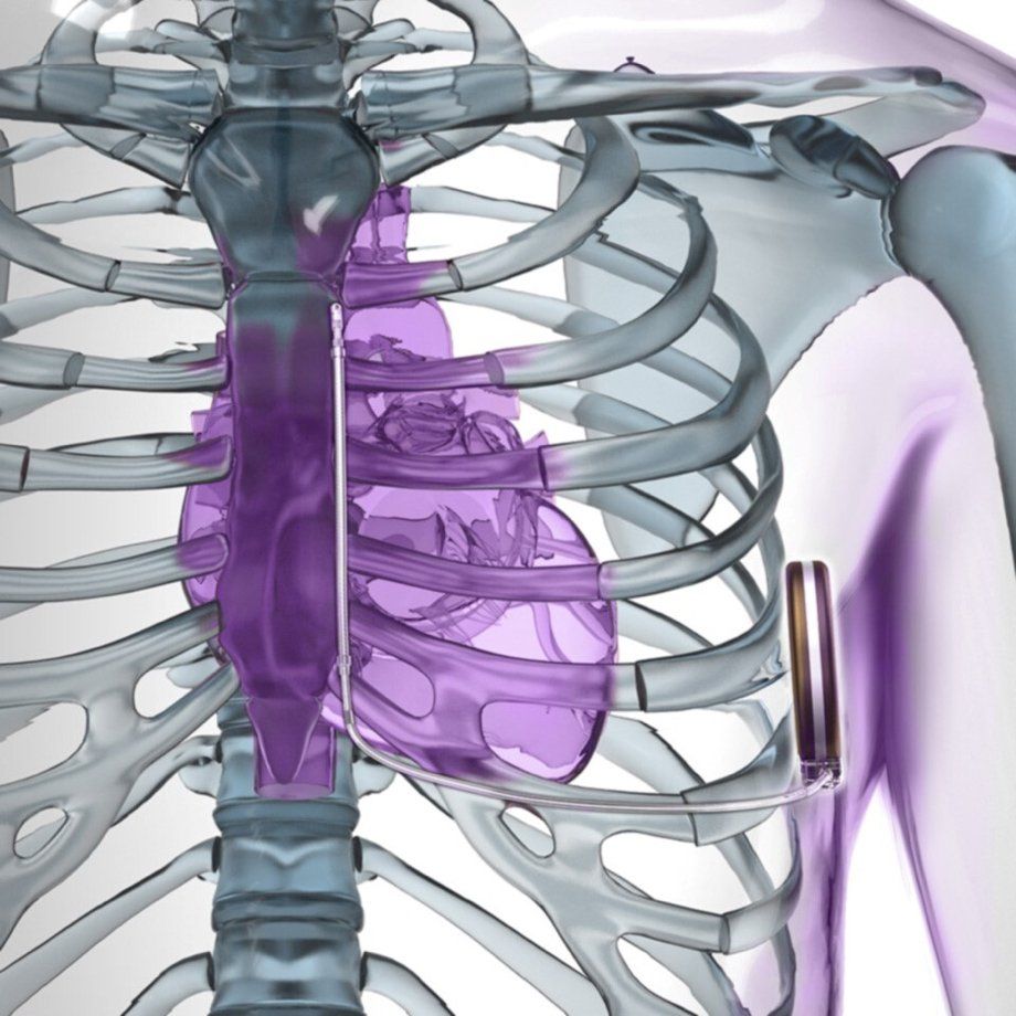 emblem s-icd implant