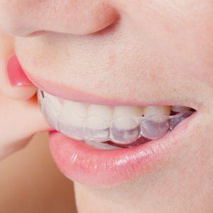 Invisible braces