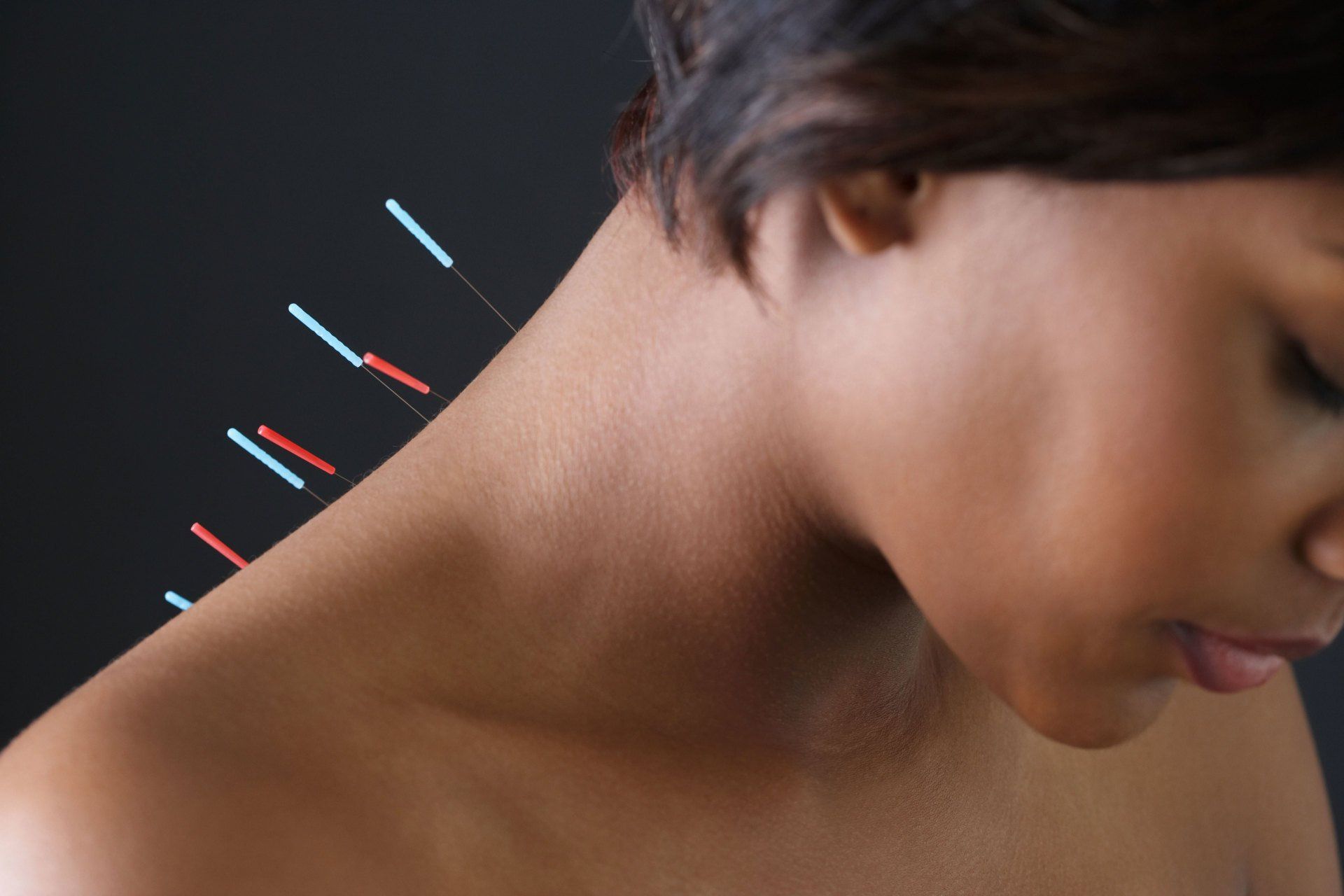 Acupuncture needles in African woman's back