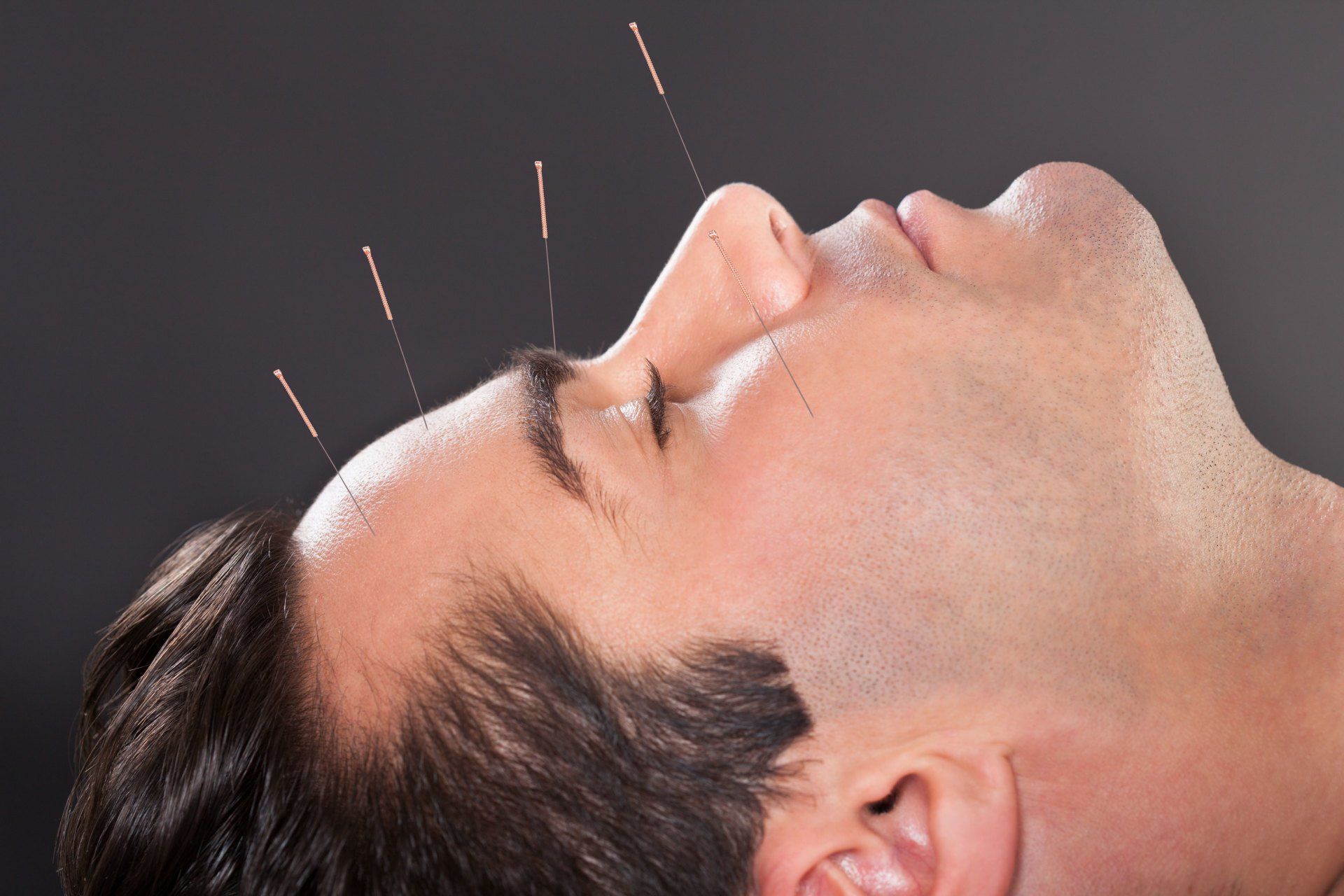 Close-up Of A Young Man Undergoing Acupuncture Treatment At Spa