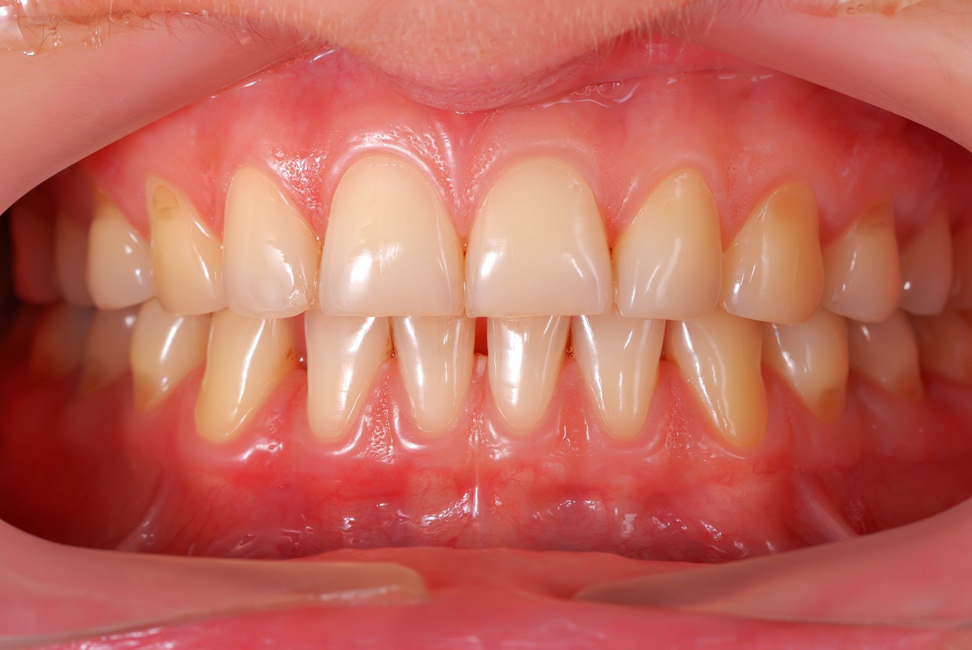 Treatment for Gum Disease