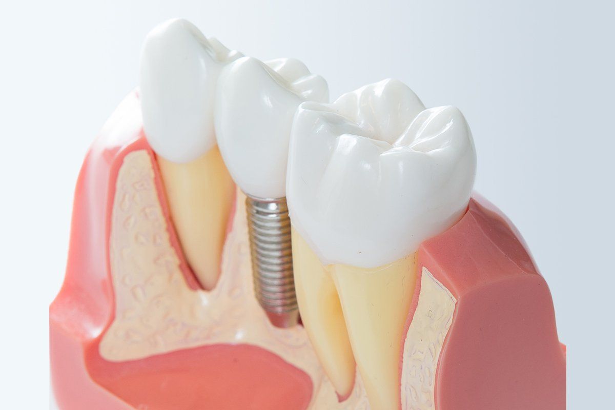 Dental Implants