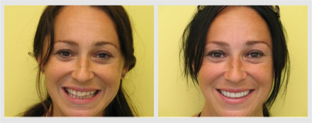 Before and After - Glenlake Dental Care