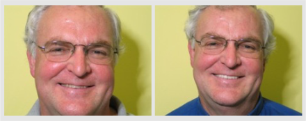 Before and After - Glenlake Dental Care