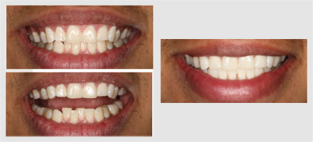 Before and After - Glenlake Dental Care